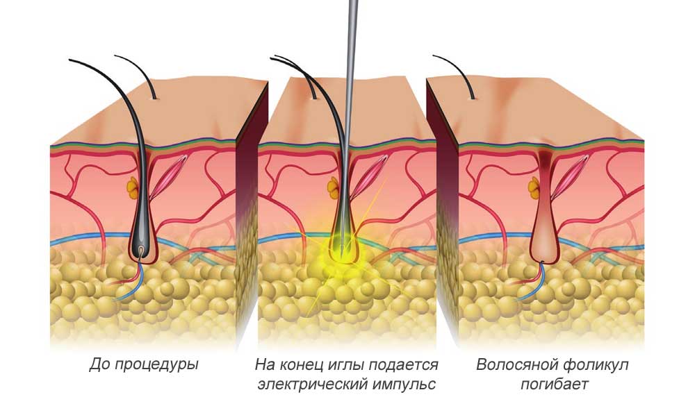 суть 'электроэпиляции