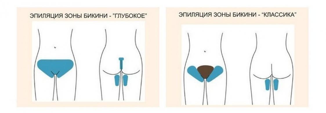 лазерная эпиляция зоны бикини