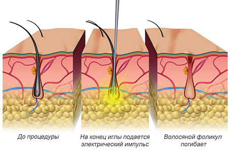 Схема воздействия электроэпиляции