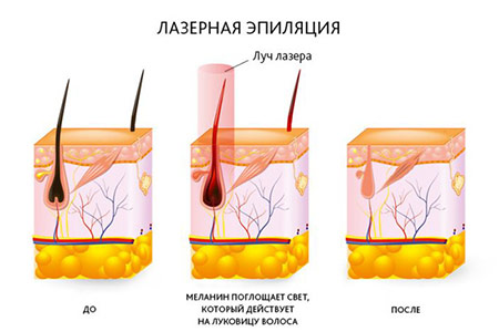 Схема воздействия лазерной эпиляции