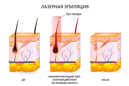 Лазерная эпиляция - удаление волос навсегда