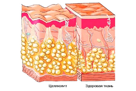 Как разогнать лимфу и избавиться от целлюлита?